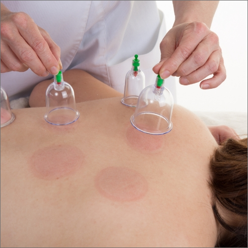 Cupping-Central-Nebraska-grand-island-physical-therapy-grand-island-ne